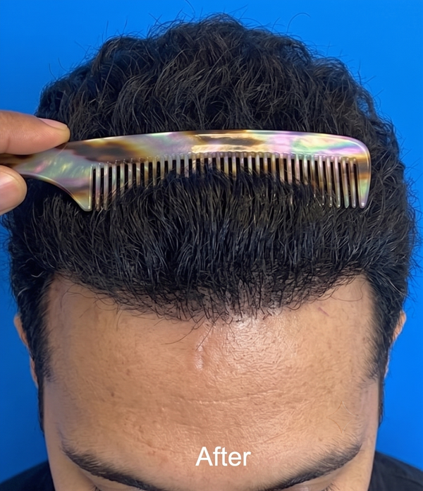 After — 