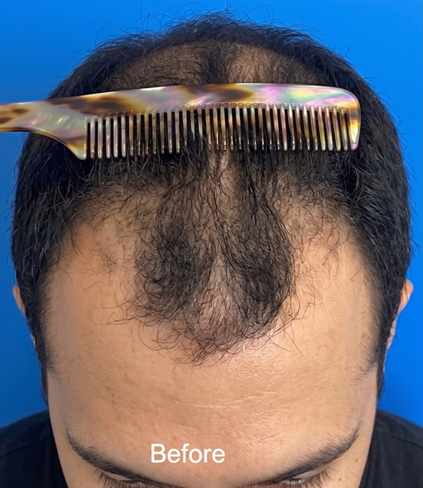 Before — 